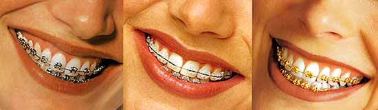 three different types of braces