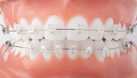 clear braces with colored bands