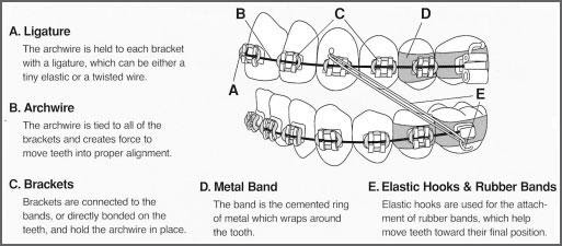Rubber bands diagram