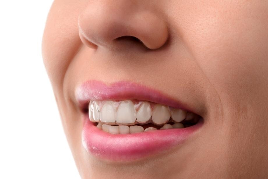 a woman smiling with a aligner in her mouth