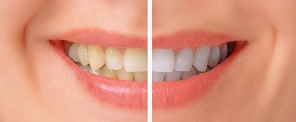 Close-up image of female teeth before and after whitening