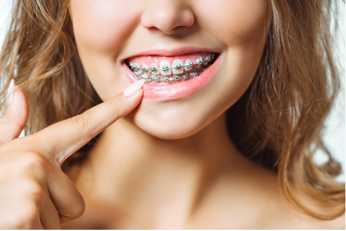 can-i-whiten-my-teeth-with-braces-mcdonough-orthodontics-of-utah