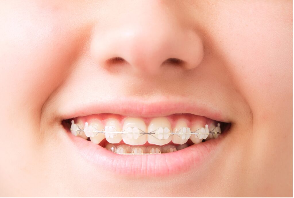 Person with braces smiling, Make Your Braces Less Noticeable