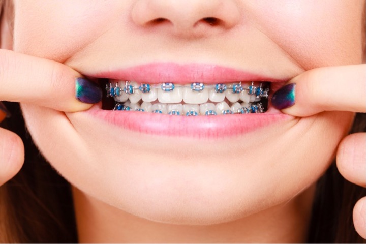 A picture containing person, cosmetic, colorized braces