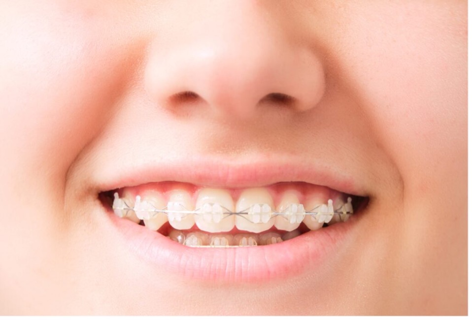 Person with braces smiling, Make Your Braces Less Noticeable