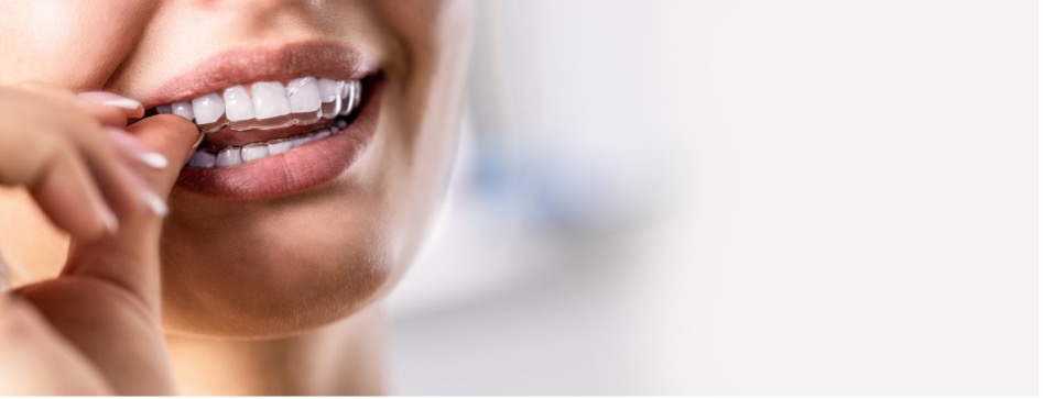 Close-up of a person's mouth, clear aligners