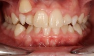 Close-up of a person's teeth before treatment