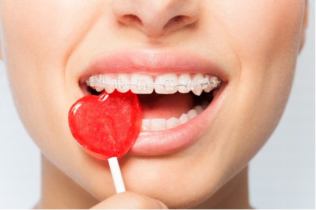 A close-up of a person with braces and a lollipop, How Sugar Affects Your Braces