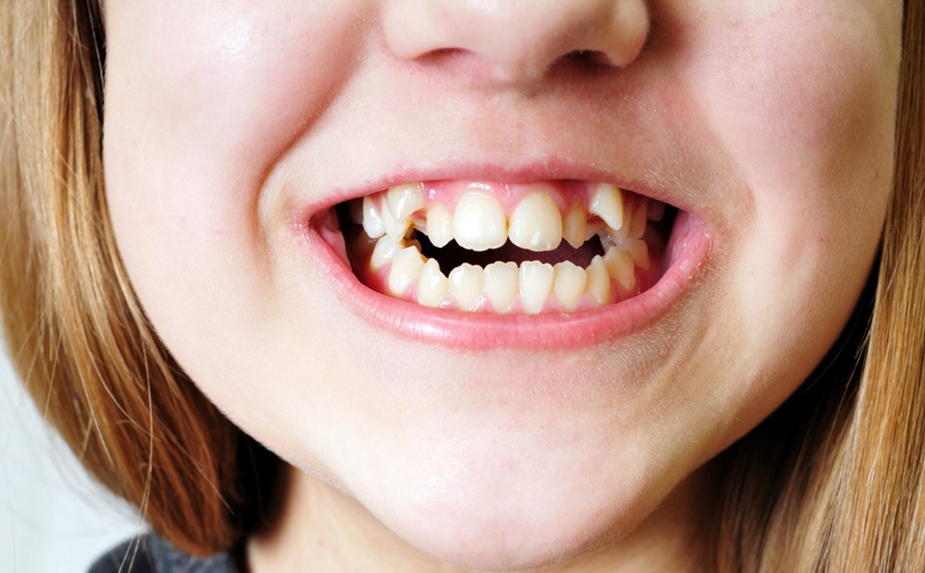 Close-up of a person's mouth showing her teeth, Making Room for a Healthy Smile: Creating Space for Teeth